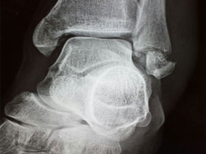 Foot and ankle x-rays