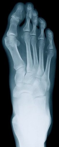 Miami Podiatrist | Miami Rheumatoid Arthritis | FL | Era Foot and Ankle, LLC |